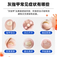 盐酸阿莫罗芬搽剂(甲泰康/诺安嘉效)